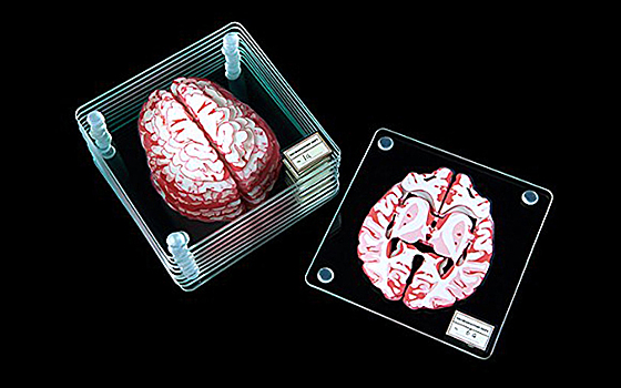 Нейробиологи: нормального мозга не бывает