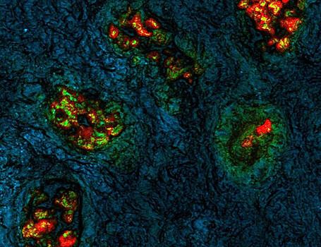 Визуализация позволит быстро отличить раковые клетки с точностью до 97%
