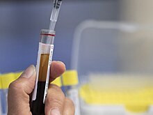 За год у более чем 400 пензенцев выявили вирусный гепатит С