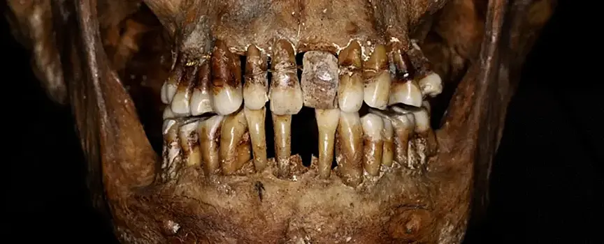 Учёные обнаружили у аристократки 17 века хитрый секрет сохранения зубов