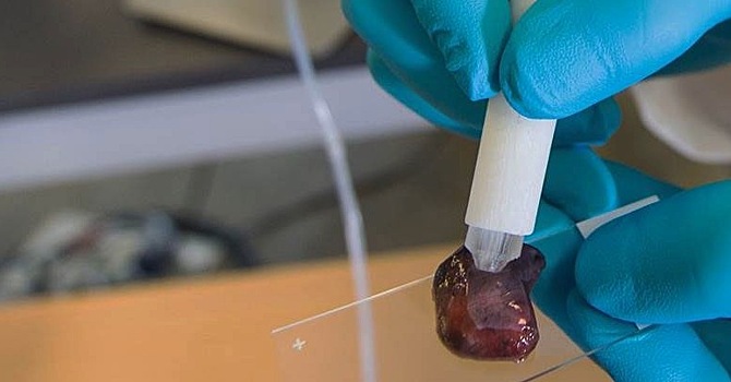 Рак можно обнаружить всего за 10 секунд