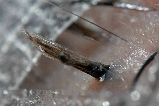 Врачи раскрыли безопасные способы избавиться от вросших волос