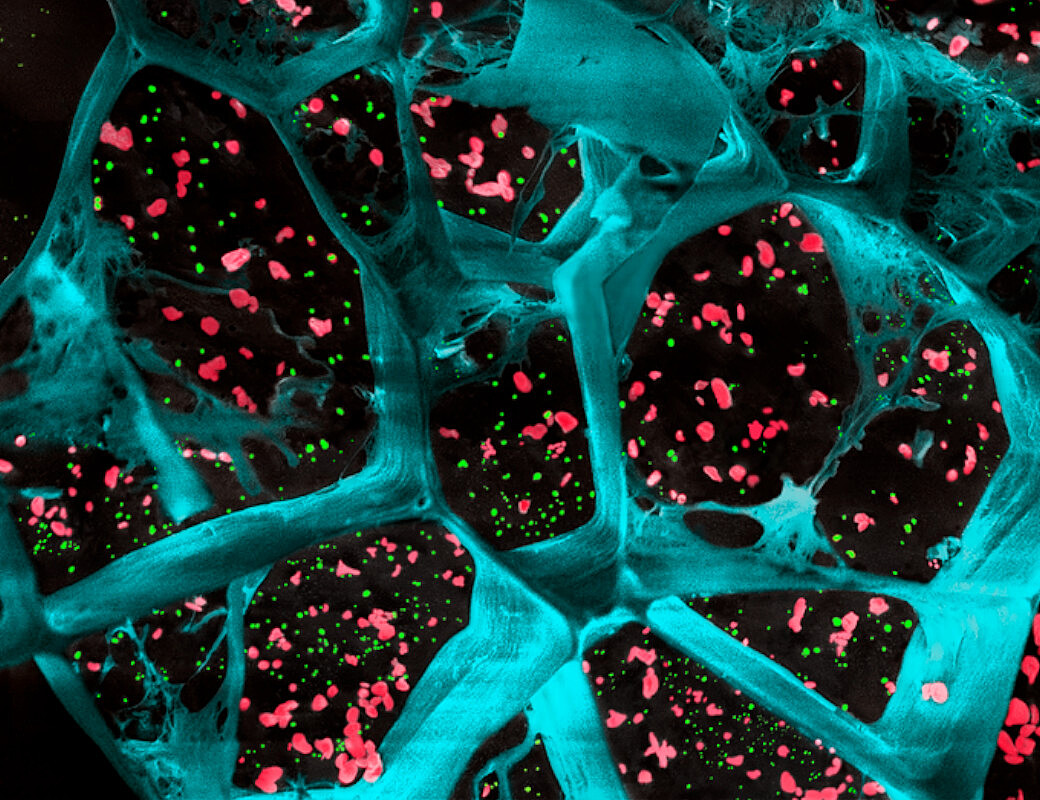 Ученые изобрели подавляющий рост раковых опухолей гель