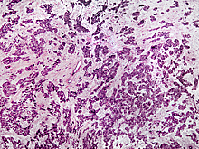 Предложен эффективный способ вылечить рак