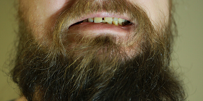 Врач рассказала о болезнях, к которым приводит неправильный прикус