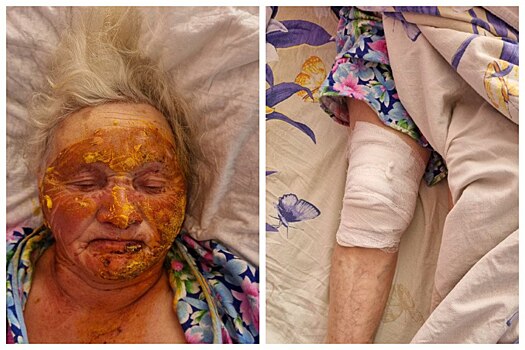 Опубликовали фото чудом выжившей при взрыве газа жительницы Новосибирской области