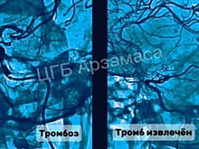 Нижегородские врачи спасли мозг пациента от тромбоза