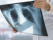 Коварное заболевание: сегодня отмечается Всемирный день борьбы с туберкулезом