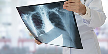 Коварное заболевание: сегодня отмечается Всемирный день борьбы с туберкулезом