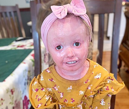 Девочка с редким синдромом и ярко-розовой кожей стала звездой Instagram
