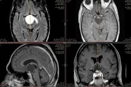 Опухоль атакует голову. Есть ли способы уберечься от рака мозга?