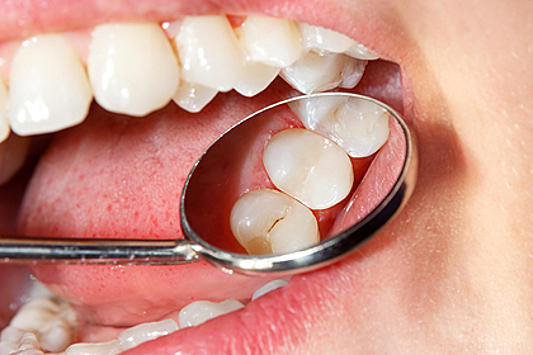 Стоматолог научил правильно чистить зубы для профилактики кариеса