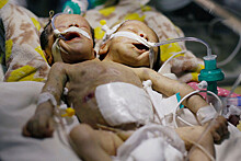 В Йемене умерли сиамские близнецы, оставшиеся без лечения