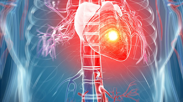 Врач Нилова: гипертония и ишемия могут стать причинами сердечной недостаточности