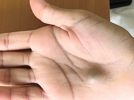 Шишка на руке после визита к дантисту оказалась опасной инфекцией