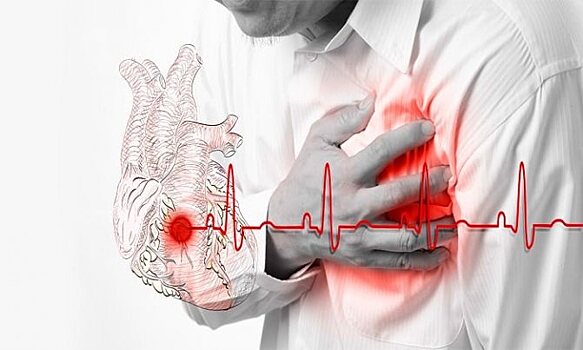 Минздрав не рекомендует применять ацетилсалициловую кислоту для профилактики инфаркта миокарда