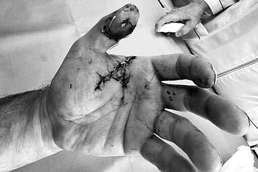 В Подмосковье мужчина неудачно уронил тарелку и попал на операционный стол