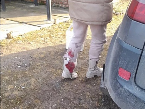 В Пскове собака напала на женщину, защищающую свою дочь