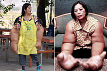 Болезнь превратила руки жительницы Таиланда в гигантские “щупальца”