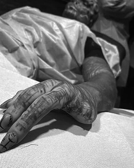 Лоффредо объявил, что ради сходства с рептилоидами удалил себе два совершенно здоровых пальца на руке.