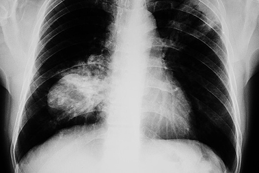 Подобный кашель указывает на рак лёгких