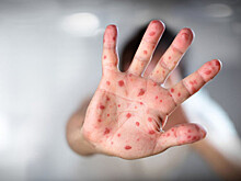 Россиян предупредили об эпидемии кори на острове Фиджи