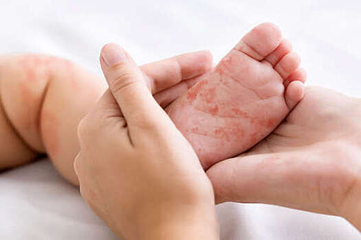 Педиатр Волков: вирус кори стирает иммунную память и делает человека беззащитным