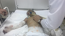Врачи ампутировали кисть и предплечье правой руки избитой девочке из Ингушетии