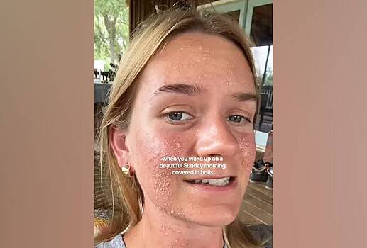 Укус паука-отшельника вызвал у женщины редкую болезнь