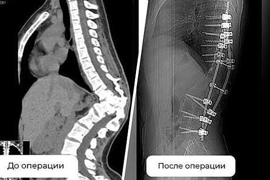 В Кургане врачи исправили девушке тяжелое S-образное искривление позвоночника
