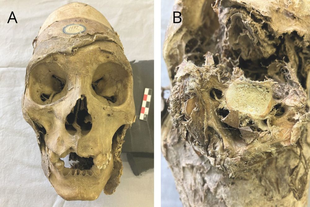 Раскрыта тайна удлиненного черепа мумии со следами трепанации