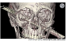 Израильские нейрохирурги спасли пациента с пробитой насквозь головой