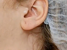 Москвички начали колоть ботокс в уши