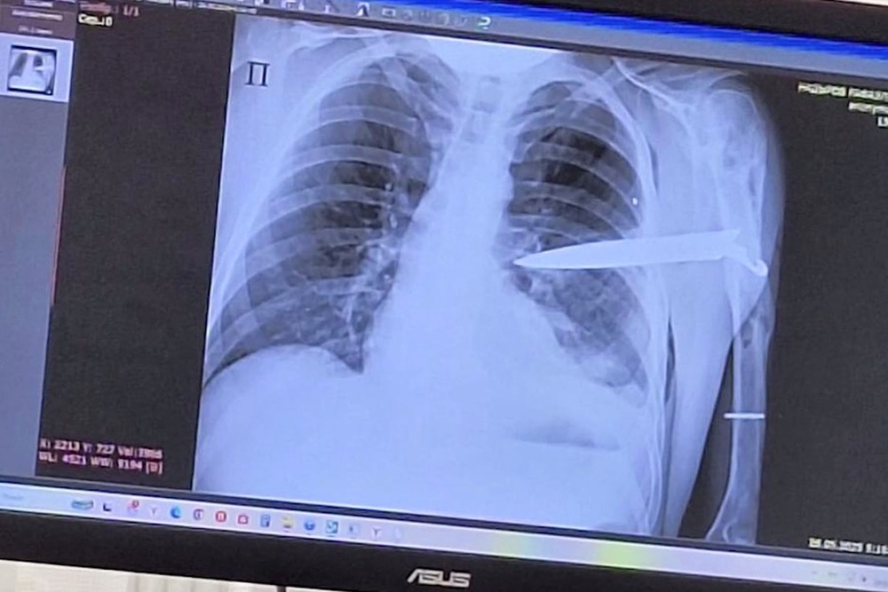 Житель Татарстана после застолья очнулся с ножом в спине