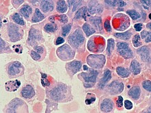 Генетик рассказал, какие виды рака можно получить по наследству