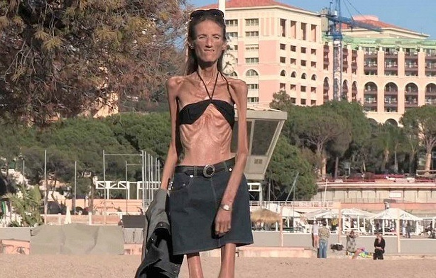 Валерию Левитину долго называли "самой худой женщиной на планете". Ее вес составлял всего 25 кг при росте 171 см. 