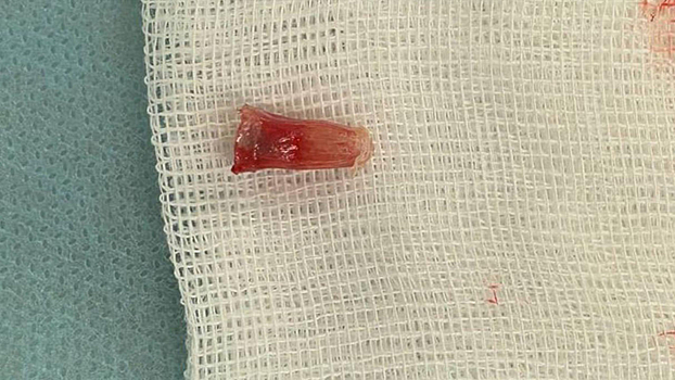 Пластиковый колпачок стал причиной полугодовой пневмонии у московского школьника