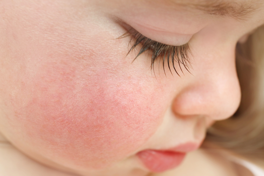 Красные щеки и сыпь на теле у ребенка: это аллергия или инфекция? -  Рамблер/женский