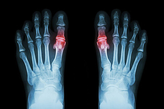 Обострение подагры повышает риск инфаркта и инсульта
