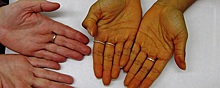 Онколог Карасев предупредил, что желтушность кожи может быть симптомом рака