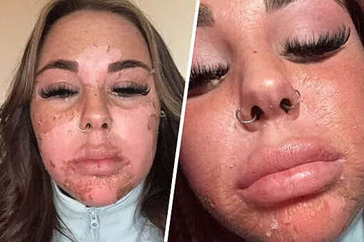 Британская блогерша показала облезшую кожу после солярия
