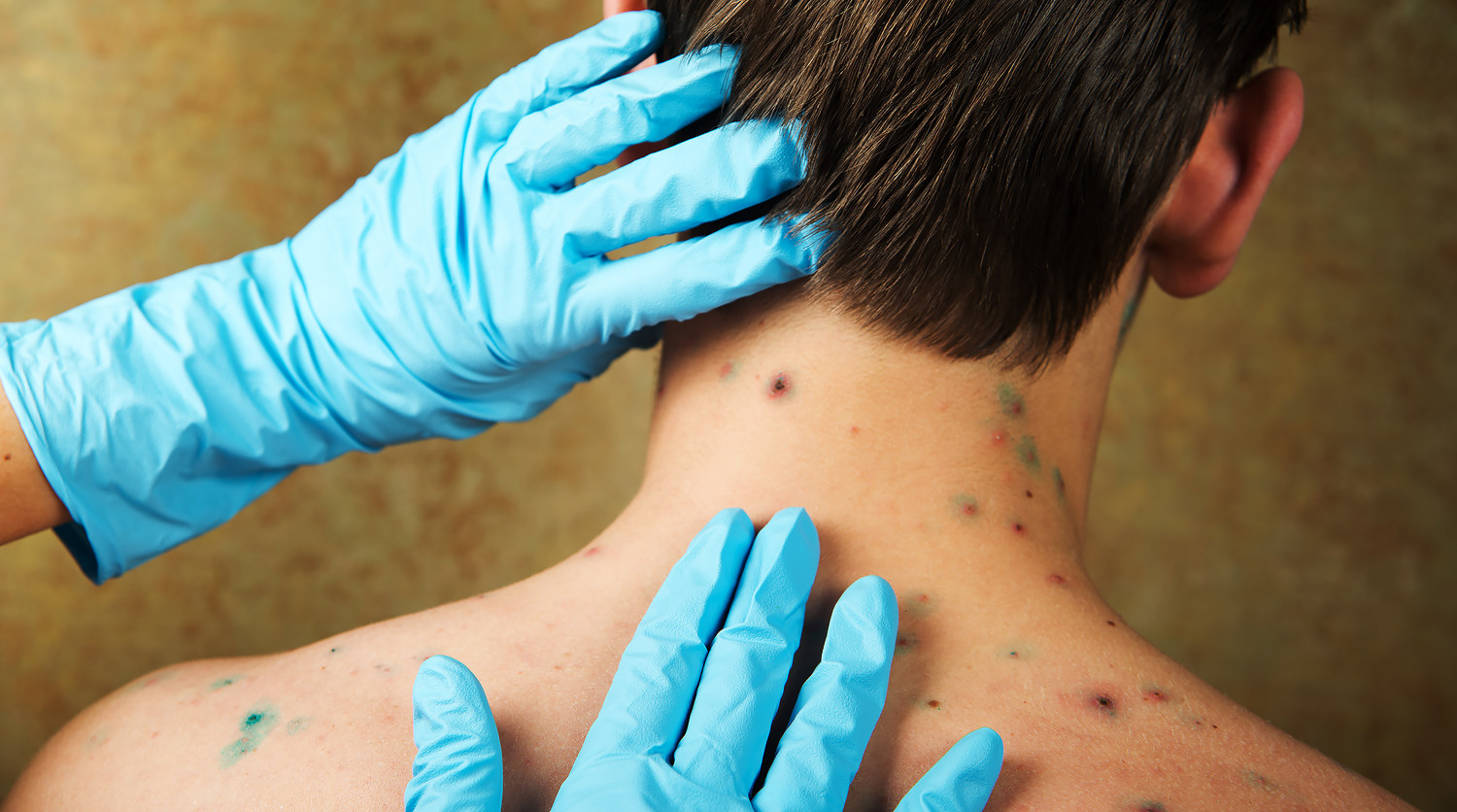 Известия: в РФ возник дефицит вакцин от ветрянки на фоне роста заболеваемости