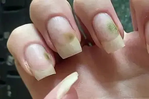 Ногти девушки заросли зеленой плесенью после неудачного маникюра
