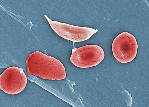 Генная терапия впервые справилась с серповидноклеточной анемией