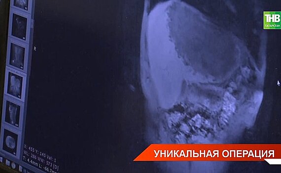 В Татарстане врачи очистили печень пациента от паразитов — видео