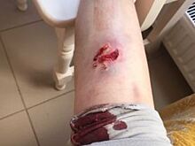 Известную рязанскую модель Наталью Соболеву сильно покусала собака
