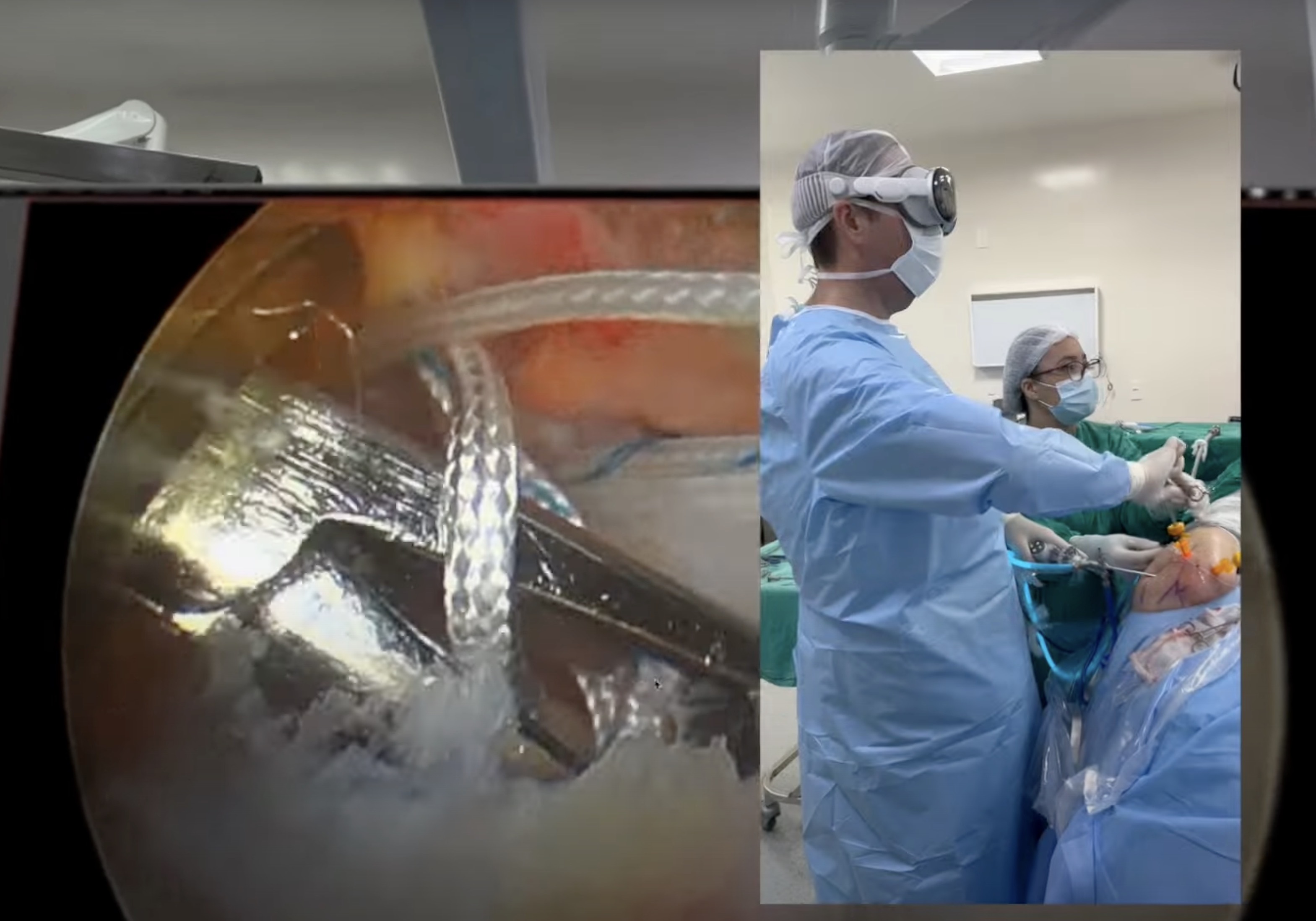 В Бразилии хирург провёл операцию на плечевом суставе в гарнитуре Vision Pro