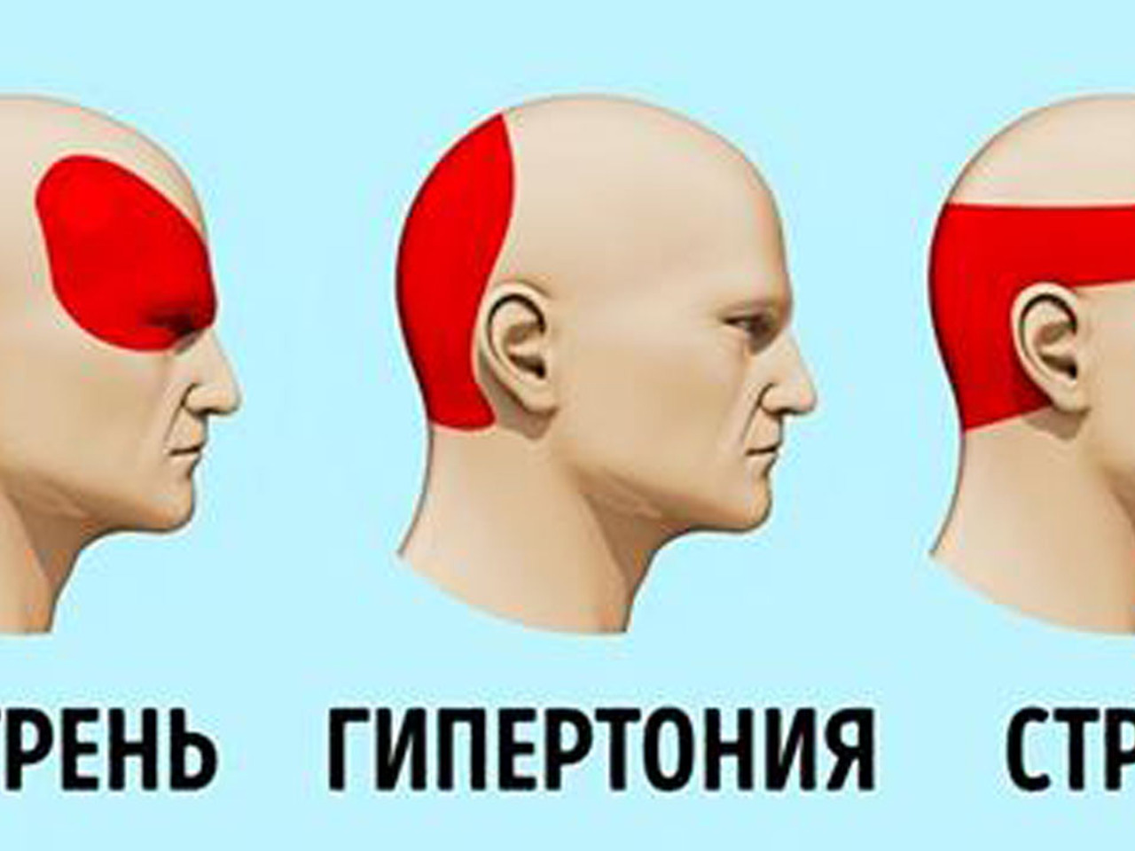 Как избавиться от головной боли без таблеток за 5 минут - Рамблер/доктор