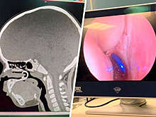 В Чувашии врачи спасли ребенка, вдохнувшего серьгу для пирсинга