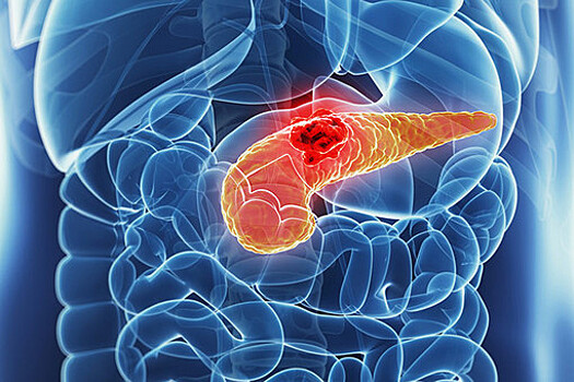 Найдены гены, спасающие при раке поджелудочной